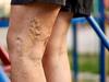 Varicose Veins: ரத்தக் குழாய்களில் தேங்கி சுருண்டு இருக்கும் ‛வெரிகோஸ் வெய்ன்’ பற்றி தெரியுமா ?