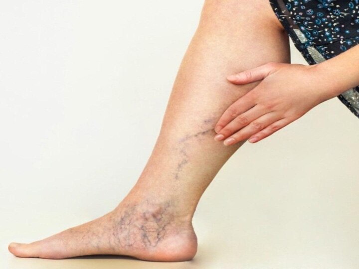 Varicose Veins: ரத்தக் குழாய்களில் தேங்கி சுருண்டு இருக்கும் ‛வெரிகோஸ் வெய்ன்’ பற்றி தெரியுமா ?