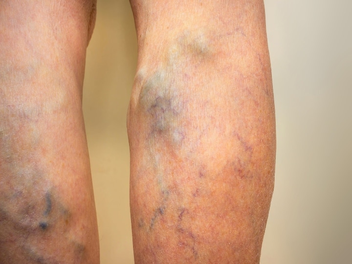 Varicose Veins: ரத்தக் குழாய்களில் தேங்கி சுருண்டு இருக்கும் ‛வெரிகோஸ் வெய்ன்’ பற்றி தெரியுமா ?