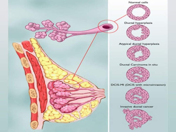 Breast Cancer Awareness Month | உஷார்.. பரிசோதனை முக்கியம்.. மார்பக புற்றுநோயில் இத்தனை வகைகளா?