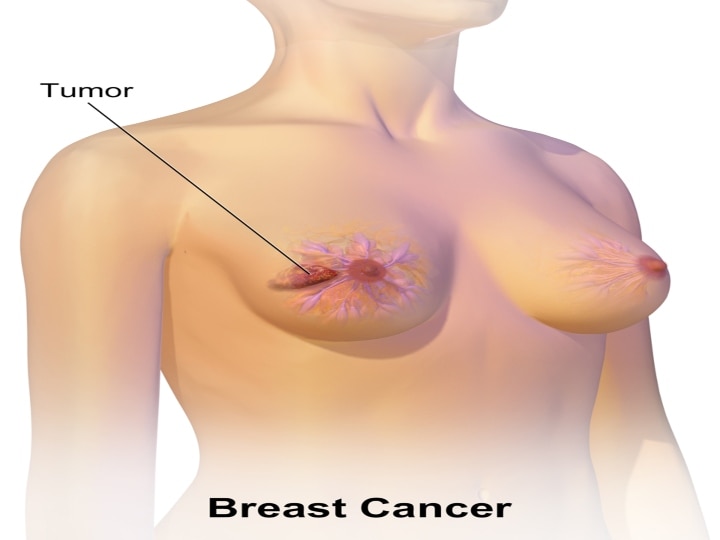 Breast Cancer and Cancer Myths | மார்பகப்  புற்றுநோய் குறித்த கட்டுக்கதைகளும் , அதற்கான விளக்கங்களும்..