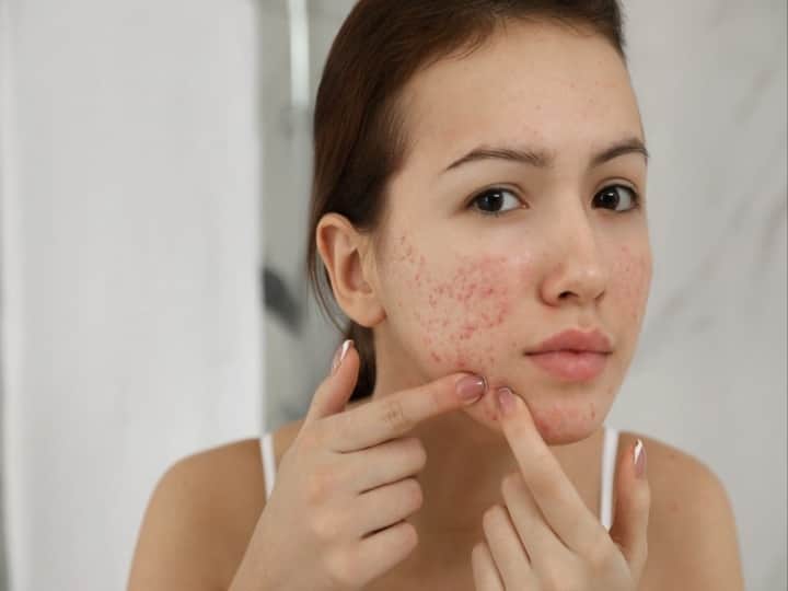 how to get rid of pimples by home remedies Skin Care: कड़वे काढ़े और महंगी क्रीम्स नहीं, ये आसान घरेलू उपाय खत्म करेंगे पिम्पल्स