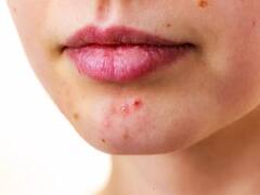 How to prevent pimples | முகப்பரு வராமல் தடுக்க இந்த 4 விஷயங்களை ஃபாலோ பண்ணுங்க!!