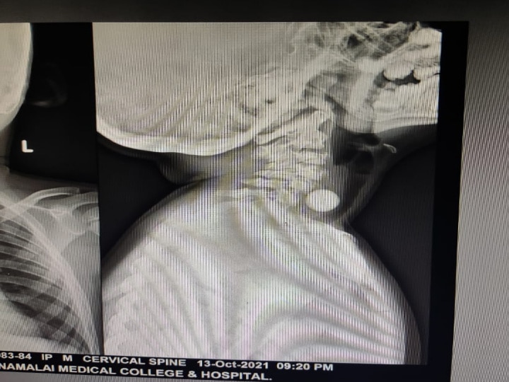 சிறுவனின் தொண்டையில் சிக்கிய கோலி குண்டு - அறுவை சிகிச்சை இன்றி அகற்றிய அரசு மருத்துவர்கள்