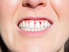 मसूड़ों के दर्द से हैं परेशान तो ये 5 घरेलू उपाय दिलाएंगे राहत