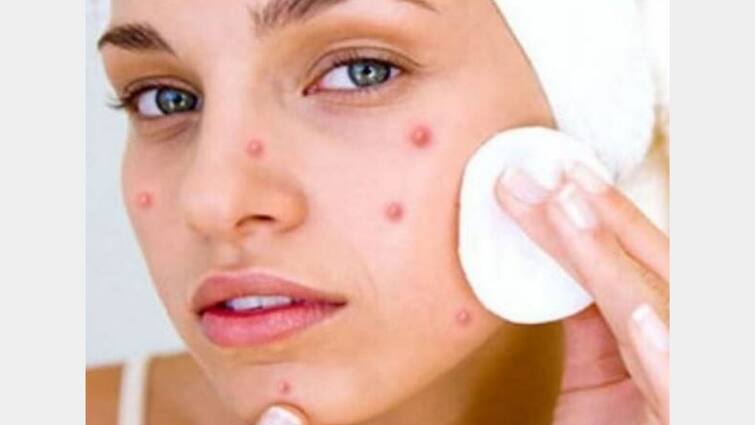 Skincare tips: Three simple hacks for acne problem, know in details Skincare Tips: ব্রণর সমস্যায় নাজেহাল? মেনে চলুন এই তিন পদ্ধতি