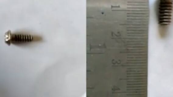 રાજકોટ: 3 વર્ષના બાળકના નાકમાં ફસાયો સ્ક્રૂ, જુઓ શું થયું બાળક સાથે ?