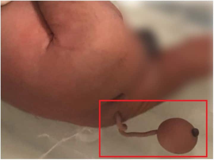 Baby born in Brazil had 12-cm-long Tail with ball-shaped mass at the tip Baby Born with Tail: పొడవైన తోకతో పుట్టిన శిశువు.. చివరిలో బంతిలాంటి భాగం