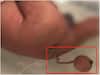 Baby Born with Tail: పొడవైన తోకతో పుట్టిన శిశువు.. చివరిలో బంతిలాంటి భాగం