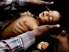 भारत में 33 लाख से अधिक बच्चे कुपोषित, इनमें से 17.7 लाख अत्यंत कुपोषित: सरकारी आंकड़े