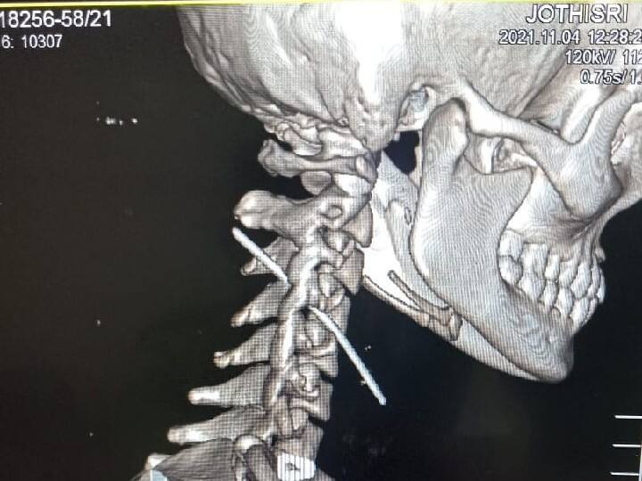 Government doctors successfully remove a 7.5 cm long sewing needle from the neck பெண்ணின் கழுத்தில் 7.5 செ.மீ தையல் ஊசி - வெற்றிகரமாக அகற்றிய அரசு மருத்துவர்கள்