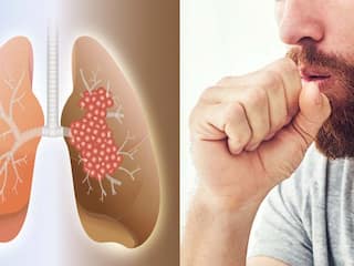 सतत खोकला येतो? श्वास घेताना त्रास होतो? जाणून घ्या 'पल्मोनरी फायब्रोसिस' विषयी..