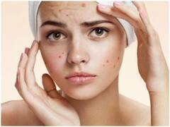 Skin Care Tips: Pimple के निशानों को हटाने के लिए लगाएं ये Toner, जानें बनाने का तरीका