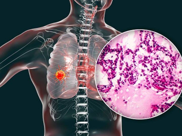 Lung Cancer Awareness Month: New Advancements In Therapy You Should Know About Lung Cancer Awareness Month: New Advancements In Therapy You Should Know About