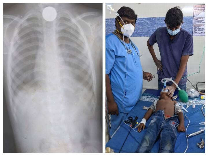 Dharmapuri Government doctors rescue boy who swallowed 5 rupee coin 5 ரூபாய் நாணயத்தை விழுங்கிய சிறுவன்: போராடி மீட்ட அரசு மருத்துவர்கள்!