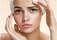 Skin Care Tips : चेहऱ्यावरील पिम्पल्स होतील दूर; 'हे' टोनर ठरेल फायदेशीर, जाणून घ्या तयार करायची सोपी पद्धत