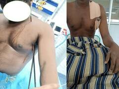 தவறி விழுந்த கொத்தனார் தோளில் பாய்ந்த கம்பிகள்: போராடி மீட்ட டாக்டர்கள்!