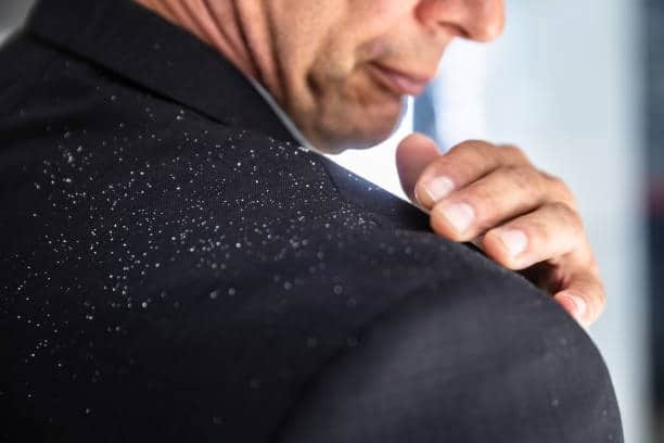 শীতকাল পড়তে না পড়তেই খুশকির (Dandruff) সমস্যায় বিরক্ত? যেকোনও সাজসজ্জাকে একেবারে নষ্ট হয়ে যায় যদি আপনার পোশাকের উপর সামান্যও খুশকি দেখা যায়।