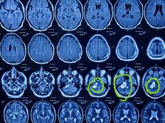 तरुणाच्या कानातून निघाली 50 ग्रॅमची गाठ, शस्त्रक्रियेनंतर सहा महिन्यांनंतर तो पुन्हा ऐकू लागला...