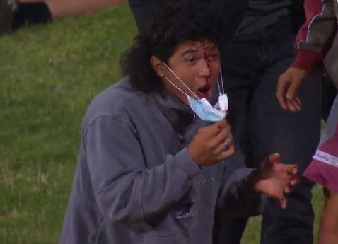 Young fan in crowd left bloodied after putting down catch during Hurricanes vs Scorchers BBL match BBL: ప్చ్.. అయ్యయ్యో.. క్యాచ్ పట్టబోయిన అభిమాని తల పగిలింది.. రక్తం వస్తుందని అతడికే తెలియలేదు