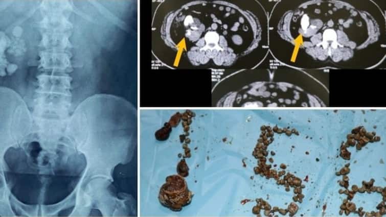 Doctors at Hyderabad hospital remove 156 kidney stones through keyhole opening Hyderabad 'ਚ ਹੈਰਾਨ ਕਰਨ ਵਾਲਾ ਮਾਮਲਾ, ਮਰੀਜ਼ ਦੇ ਗੁਰਦੇ 'ਚੋਂ ਕੱਢੀਆਂ 156 ਪੱਥਰੀਆਂ