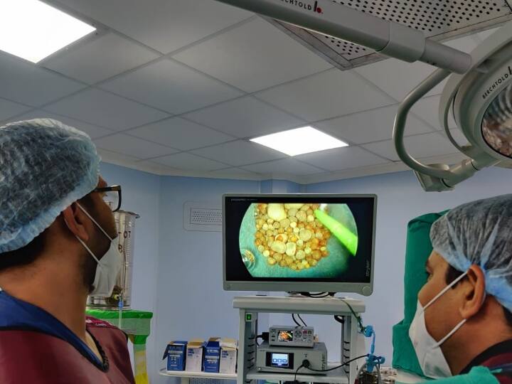 Udaipur Rajasthan MB Hospital Doctors performed a surprising operation 160 stones removed from patient stomach ANN Udaipur News: ऑपरेशन करते वक्त मरीज के पेट में ऐसा क्या मिला कि डॉक्टर भी रह गए हैरान