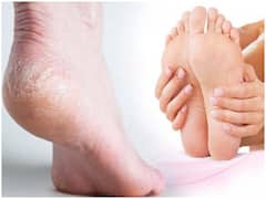Health Tips: Winter में आप भी हैं फटी एड़ियों से परेशान? ट्राई करें ये Homemade Pack, तुरंत मिलेगा आराम