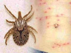 Telangana: Hyderabad Records 15 Scrub Typhus Cases, Patients Admitted To Gandhi Hospital