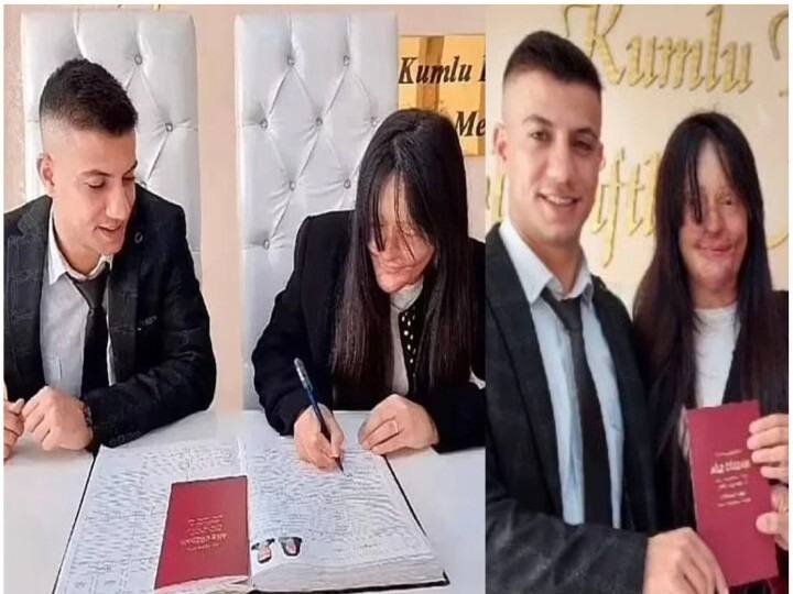 Turkish girl got married to boyfriend who threw acid on her face Trending : आधी अ‍ॅसिड तोंडावर फेकलं... पश्चात्ताप झाल्यानंतर त्याच तरुणीसोबत लग्न