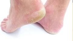 Winter Care: ঘরোয়া পদ্ধতিতে সারিয়ে ফেলুন ফাটা গোড়ালি