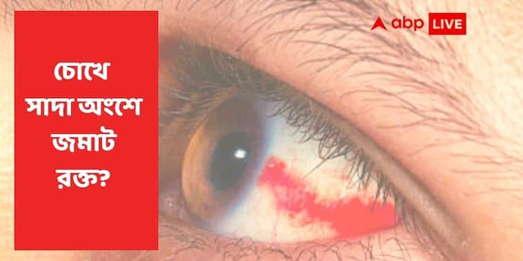 Eye Problem Red Clot in Cornea subconjunctival hemorrhage Symptoms, Effect, Treatment ABP Exclusive Red Clot In Sclera : চোখের সাদা অংশে রক্ত জমাট বিন্দু ! দৃষ্টিশক্তির ক্ষতি করতে পারে কি?