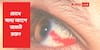Red Clot In Sclera : চোখের সাদা অংশে রক্ত জমাট বিন্দু ! দৃষ্টিশক্তির ক্ষতি করতে পারে কি?