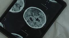 Tuberous sclerosis: রোগের নাম টিউবেরাস স্ক্লেরোসিস, গিলে নিতে পারে শৈশব