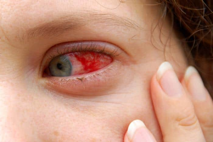 Red Eyes: Know The Causes And Symptoms Of This Disease | Red Eyes: চোখ লাল  হয়ে জল পড়ছে? সমস্যা থেকে বাঁচতে মেনে চলুন এই উপায়গুলি