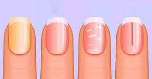 Nails Shape And Colour: ਤੁਹਾਡੀ ਸਿਹਤ ਦੀ ਸਥਿਤੀ ਤੁਹਾਡੇ ਨਹੁੰਆਂ ਦੀ ਬਣਤਰ, ਰੰਗ ਤੇ ਆਕਾਰ ਤੋਂ ਲੱਗ ਸਕਦਾ ਹੈ। ਤੁਹਾਡੇ ਨਹੁੰਆਂ ਨੂੰ ਦੇਖ ਕੇ ਤੁਹਾਡੀ ਸਿਹਤ ਬਾਰੇ ਬਹੁਤ ਕੁਝ ਜਾਣਿਆ ਜਾ ਸਕਦਾ ਹੈ। ਕਈ ਲੋਕਾਂ ਨੂੰ ਨਹੁੰਆਂ ਦੀ ਬਣਤਰ ਤੇ ਰੰਗ ਦੇਖ ਕੇ ਸਿਹਤ ਦਾ ਅੰਦਾਜ਼ਾ ਲੱਗ ਜਾਂਦਾ ਹੈ।