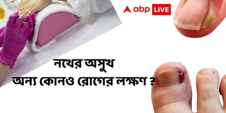 Nail Infection Nail Damage Can Be the Symptoms Of Underlying Disease  Dr Suddhasatwya Chatterjee explains Nail Infection : নখ ভেঙে যাচ্ছে? পচে যাচ্ছে? অন্য কোনও রোগের লক্ষণ নয় তো?