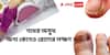 Nail Infection : নখ ভেঙে যাচ্ছে? পচে যাচ্ছে? অন্য কোনও রোগের লক্ষণ নয় তো?