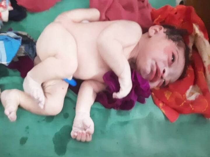 Unique Baby Gopalganj: गोपालगंज में चार पैर और तीन हाथ वाले बच्चे को देखकर डॉक्टर भी हैरान, एक लाख में आते हैं एक केस
