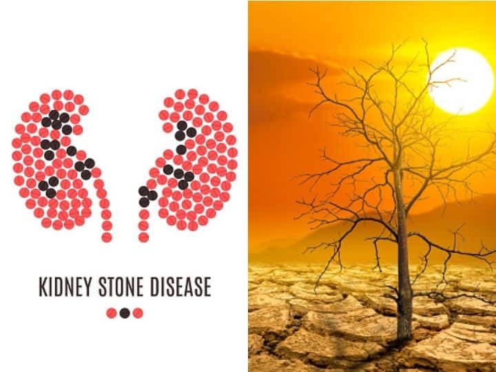 Rise In Kidney Stone Cases Due To Climate Change? Study Says Yes, Explains Why Rise In Kidney Stone Cases Due To Climate Change? Study Says Yes, Explains Why