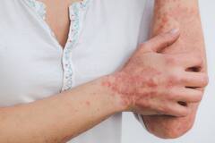 Atopic Dermatitis: কী কারণে হয় একজিমা? সারানোর উপায় কী?