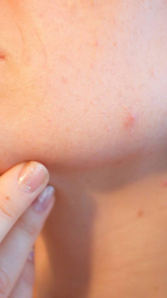 কীভাবে ঠেকানো যায় একজিমা?