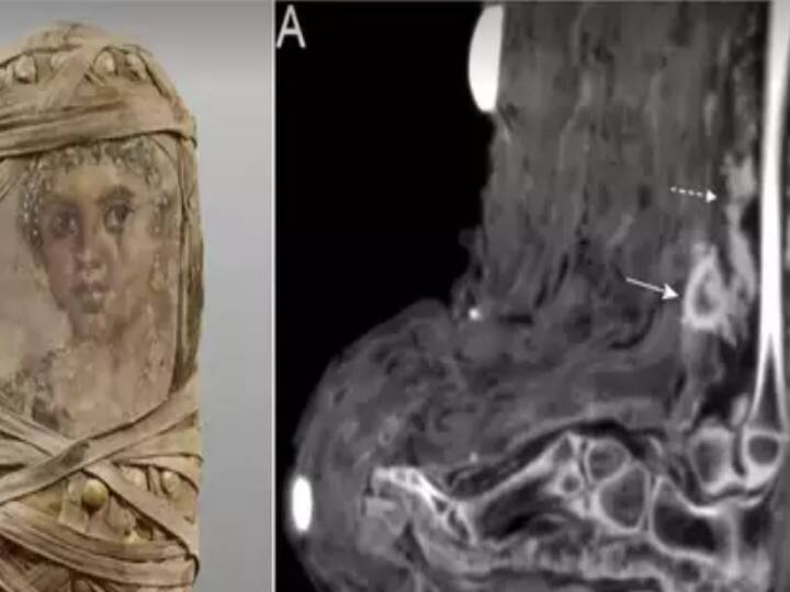 Scientists found evidence of bandaged wound in the mummy of a girl for the first time Trending: वैज्ञानिकों को पहली बार बच्ची की ममी में मिले पट्टी बंधे घाव के सबूत, प्राचीन चिकित्सा पद्धति को जानने में महत्पूर्ण साबित हो सकती है यह खोज