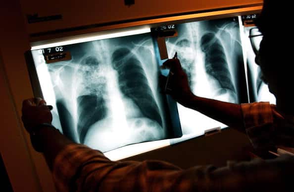 Test For TB If Cough Persists For More Than 2-3 Weeks: Govt Guidelines For Covid Patients Test For TB If Cough Persists For More Than 2-3 Weeks: Govt Guidelines For Covid Patients