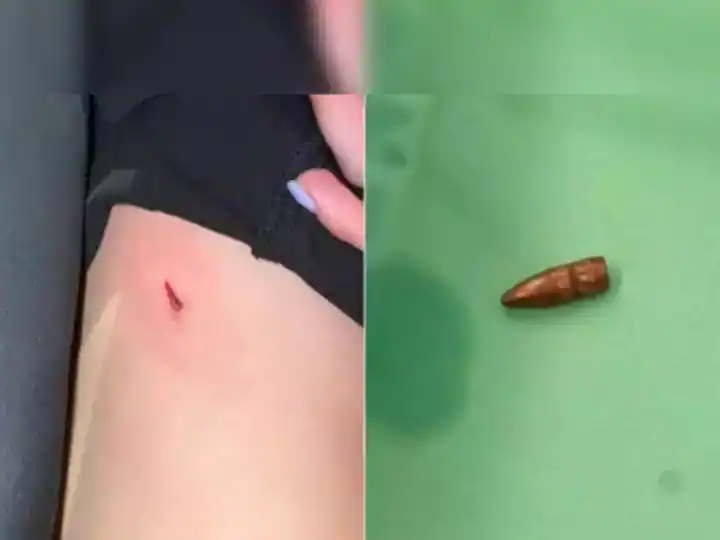 Woman did not know the bullet inside her body after surgery ਵਿਆਹ 'ਚ ਔਰਤ ਨੂੰ ਵੱਜੀ ਗੋਲੀ, ਕਈ ਮਹੀਨੇ ਪਤਾ ਹੀ ਨਹੀਂ ਲੱਗਾ, ਜਾਣੋ ਫਿਰ ਕੀ ਹੋਇਆ?