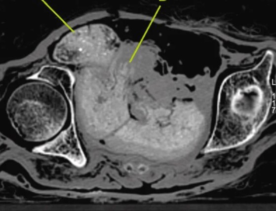 Fetus Inside Egyptian Mummy : 2000 वर्ष जुन्या इजिप्शियन ममीच्या पोटात 28 महिन्यांचा गर्भ, आतापर्यंत कसा राहिला सुरक्षित?