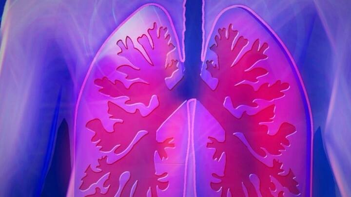 সাধারণ অবস্থায় বেশির ভাগ ক্ষেত্রেই এই রোগ ধরা পড়ে না। স্ক্যান এবং এক্স রে-তে ফুসফুসের ছবি দেখে রোগ নির্ণয় করা হয়। এই রোগের কোনও চিকিৎসা এখনও পর্যন্ত নেই। তবে অ্যান্টিবায়োটিক প্রয়োগে কিছুটা হলেও স্বস্তি পেতে পারেন রোগী।