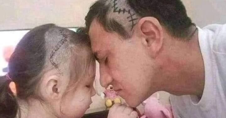 Man Shaves Head To Look Like His Daughter After Her Brain Surgery, Viral Picture Leaves People Teary-eyed Father Love :  నాన్నంటే ధైర్యం.. నాన్నంటే బలం  ! బిడ్డ కళ్లలో ధైర్యం కోసం ఆ నాన్న ఏం చేశారంటే..?