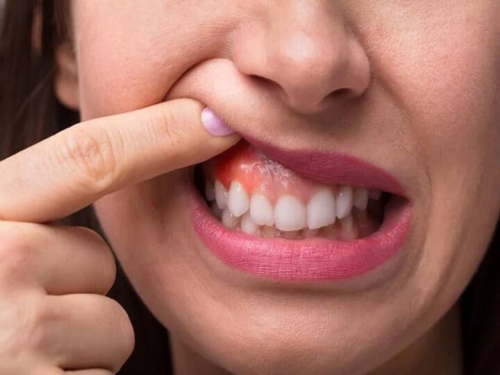 bleeding in gums? try this home remedy its helpful for you before discussing with doctor பல் ஈறுகளில் ரத்தக்கசிவு ஏற்படுகிறதா? மருத்துவரை சந்திப்பதற்கு முன்பாக இந்த டிப்ஸ் பலனளிக்கும்...