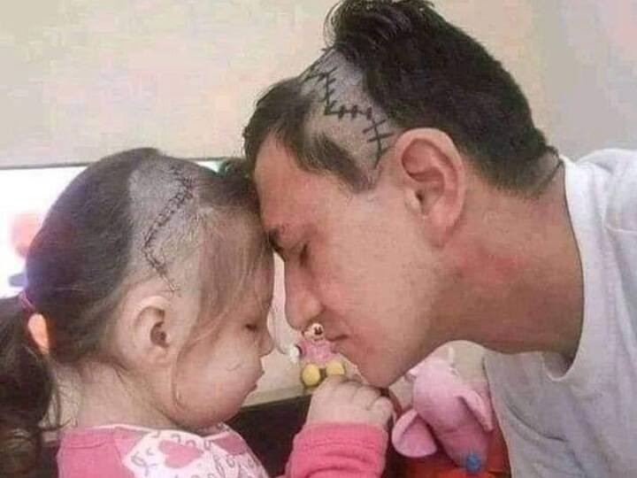 Image of Father and Daughter getting viral on social media, See this heart touching image Trending News : बेटी को न हो ब्रेन सर्जरी का अहसास, इसलिए पिता ने भी करा लिया उसके टांके जैसा हेयर स्टाइल