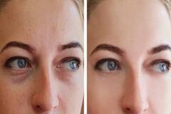 પુરી ઊંઘ લીધા બાદ પણ સવારમાં આપની આંખો  આ કારણે  સોજી જાય છે?  આ સરળ ઉપાયથી મેળવો છૂટકારો